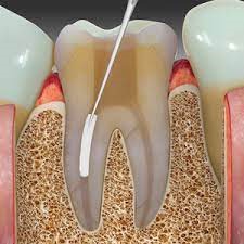 m/پر کننده کانال ریشه دندان چیست؟